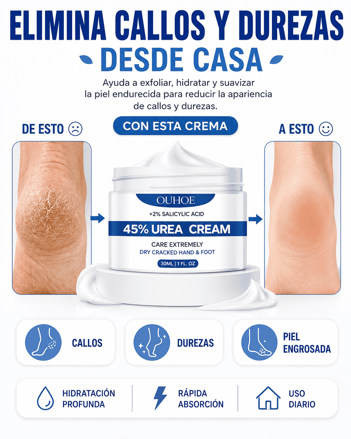 Crema para Callos OUHOE - Vuelve a usar sandalias con confianza (Copia)